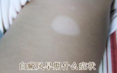 女性下巴患病白癜风如何治疗好得